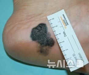 [서울=뉴시스] 발바닥에 발생한 말단흑자흑색종. (사진= 서울성모병원 제공)