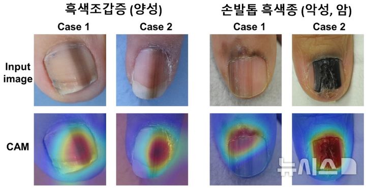 [서울=뉴시스] 흑색조갑증(양성)에 비해 손발톱 흑색종(악성, 암)은 빠르게 넓어지거나 진해지는 경우가 많으며, 손톱 주변의 피부까지 퍼지는 양상을 보인다. 흑색종은 불규칙하고 다양한 색상을 나타내며, 손발톱이 갈라지거나 부서지는 경향이 동반되기도 한다. AI가 두가지를 구분하는데에 중요한 부분을 활성화해 보여주고 있다. (사진= 세브란스병원 제공) 