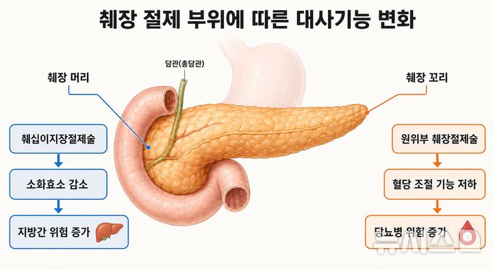 [서울=뉴시스] 췌장 절제 부위에 따른 대사기능 변화 개념도. (사진= 분당서울대병원 제공)