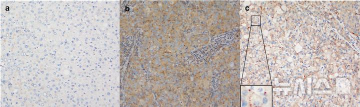 [서울=뉴시스] LAMTOR2 발현의 대표적인 면역조직화학(IHC) 이미지. (사진= 서울대병원 제공)