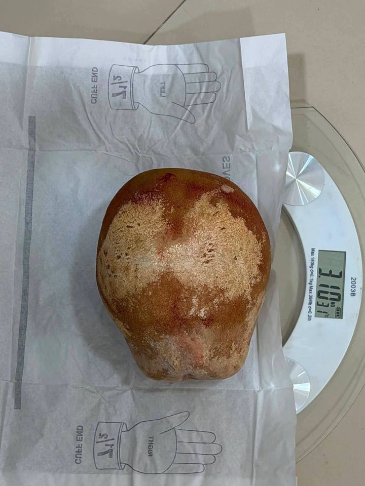 [서울=뉴시스] 스리랑카의 한 병원에서 뇌졸중으로 입원한 50대 남성의 방광에서 무게 3.1㎏에 달하는 초대형 결석이 발견됐다. (사진=페이스북 Mohammed Arshad 캡처)