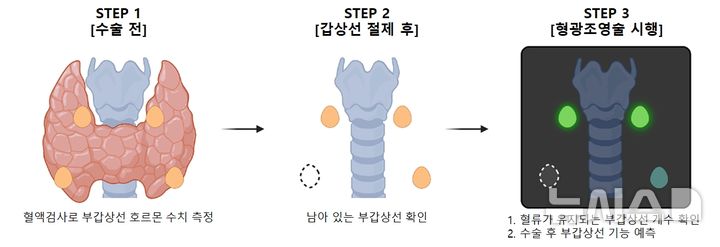[서울=뉴시스] 수술 전 부갑상선 기능과 수술 중 로봇 형광조영술로 확인한 부갑상선 혈류를 연구팀이 만든 계산식에 대입하면, 환자 10명 중 7명에서 수술 후 부갑상선 기능을 오차 범위 내로 미리 예측할 수 있다. (사진= 분당서울대병원 제공)