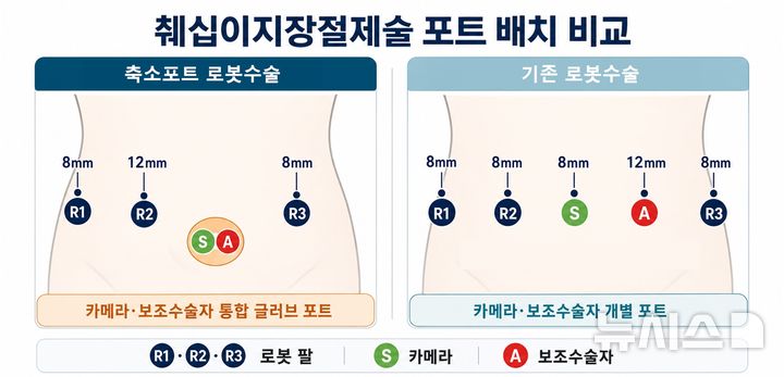 [서울=뉴시스] 췌십이지장절제술 포트 배치 비교. 축소포트는 카메라와 보조수술자가 통합 글러브 포트를 이용한다. (사진= 분당서울대병원 제공)