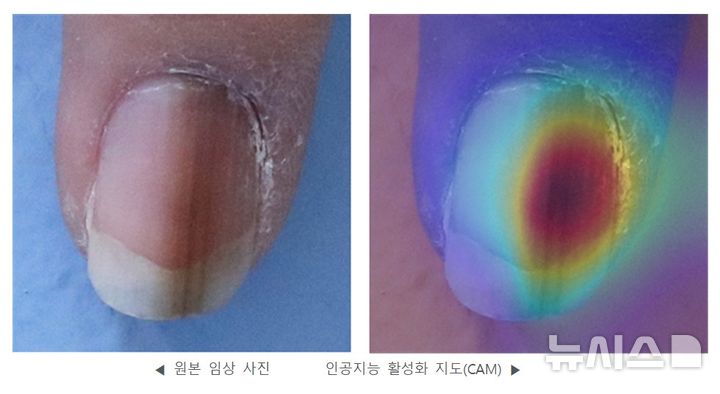 [서울=뉴시스] AI가 양성 흑색조갑증으로 판단한 환자 사례. (사진= 세브란스병원 제공)