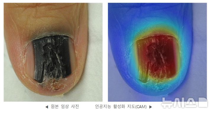 [서울=뉴시스] AI가 즉시 검사가 필요한 흑색종으로 판단한 환자 사례. (사진= 세브란스병원 제공)