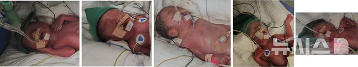 [서울=뉴시스] 오둥이 탄생 첫날. (사진= 서울성모병원 제공) 