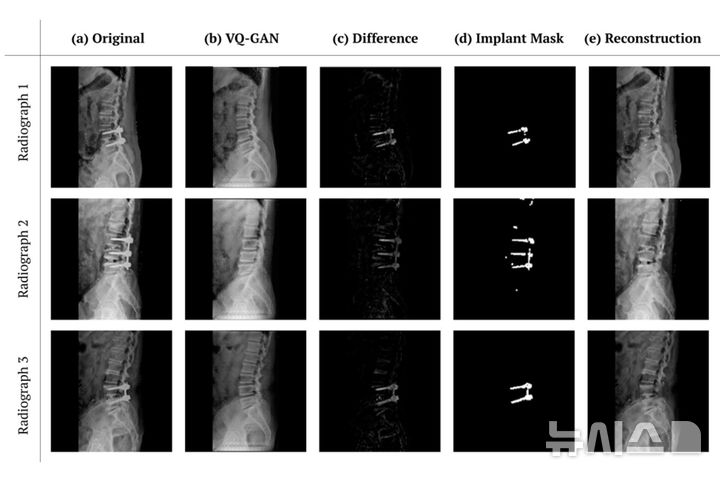 [포항=뉴시스] 한동대-에스포항병원 연구진이 척추 수술 후 X-ray 분석 AI 'ARNAI'를 개발했다. 사진은 ARNAI가 수술 후 X-ray 영상으로부터 임플란트를 제거하는 과정. (사진=한동대 제공) 2026.09.28. photo@newsis.com