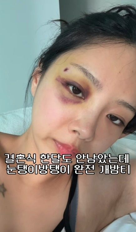 [서울=뉴시스] '나는솔로' 10기 옥순인 김슬기가 멍든 눈을 보여주고 있다. (사진=김슬기 SNS 캡처) 2026.09.30. photo@newsis.com *재판매 및 DB 금지