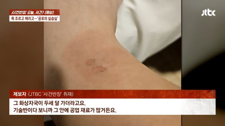 [서울=뉴시스] 피해 학생 발목에 남은 흉터 사진. (사진=JTBC '사건반장' 캡처) 2026.10.01 *재판매 및 DB 금지