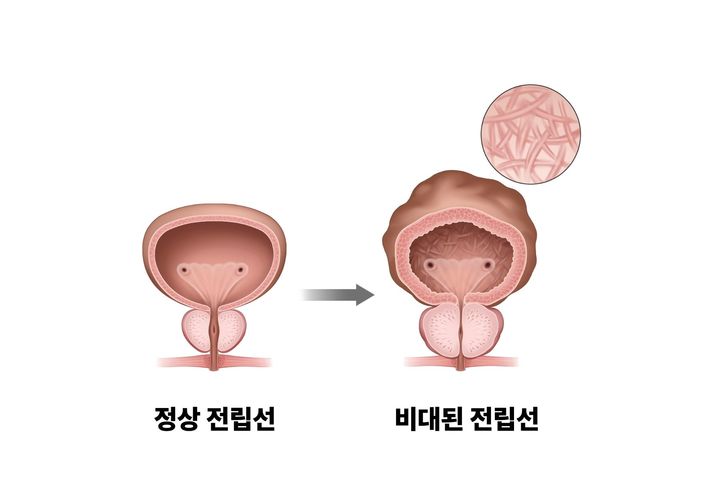 [서울=뉴시스] 2일 의료계에 따르면 전립선비대증은 50대 이상의 남성에서 나타나는 대표적인 전립선 질환이다. (사진=서울아산병원 제공) 2026.10.02. photo@newsis.com *재판매 및 DB 금지