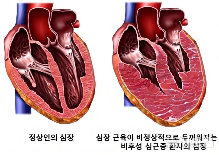 [서울=뉴시스] ] 비후성 심근증 모식도. (사진= 서울대학교병원 제공)