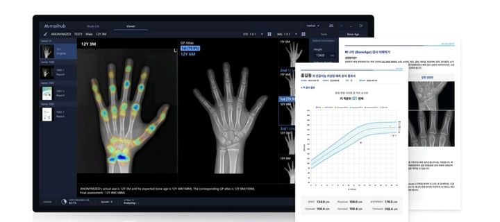 [서울=뉴시스] 17일 의료 AI 업계에 따르면 의료 AI 플랫폼 기업 마이허브는 지난해 9월 뷰노의 골연령 분석 솔루션 '뷰노메드 본에이지(VUNO Med-BoneAge)'를 인수한 이후 제품 고도화와 사용자 편의성 개선에 나섰다. (사진=마이허브 제공) 2026.10.16. photo@newsis.com *재판매 및 DB 금지