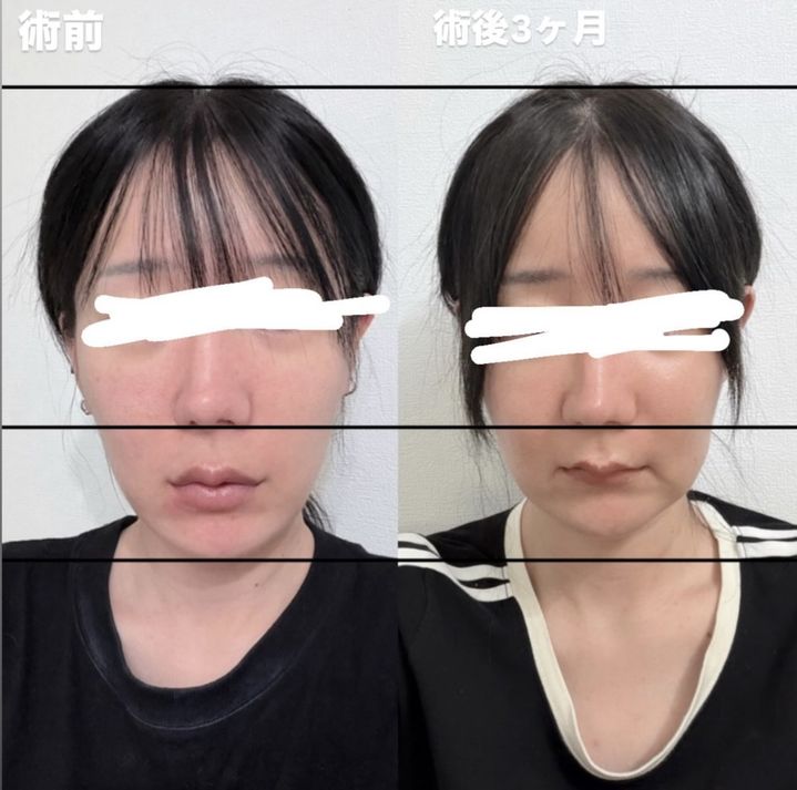 [서울=뉴시스] 일본 방송인 다다가 한국에서 양악·안면윤곽 수술을 받은 뒤 3개월이 지나도록 입과 턱 주변의 감각이 돌아오지 않는다고 호소했다. 사진은 다다가 공개한 수술 전후 모습. (사진=다다 인스타그램 캡처) *재판매 및 DB 금지