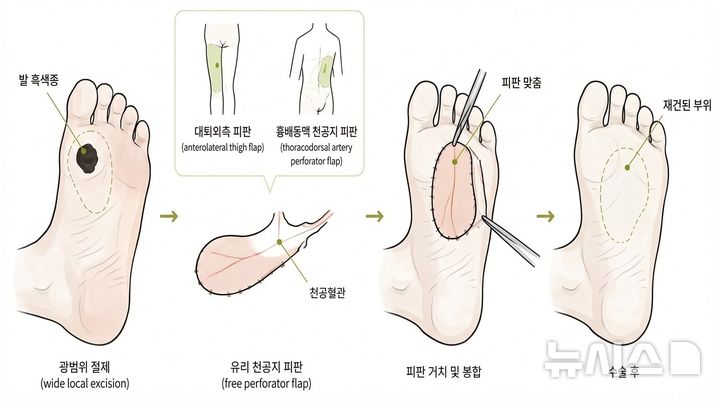 [서울=뉴시스] 발 흑색종 재건 수술에서 유리 천공지 피판술 개념도. (사진= 삼성서울병원 제공)